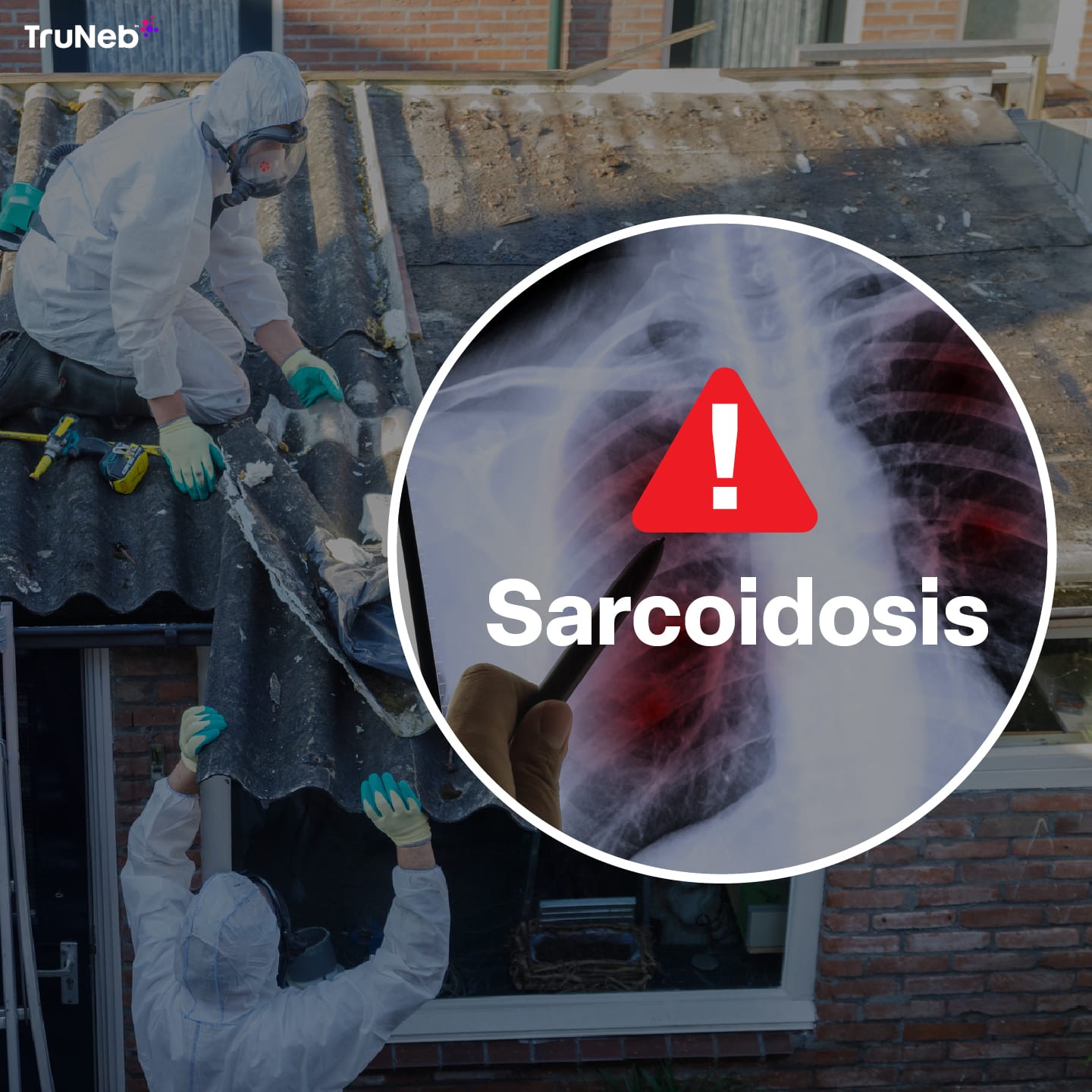 Asbestos Exposure and Sarcoidosis – A Connection?